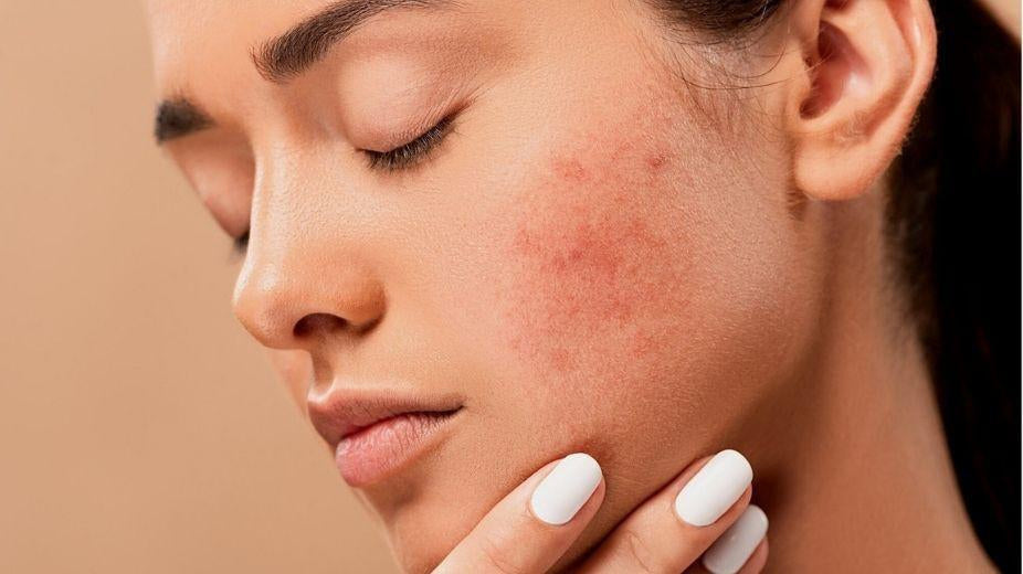 Woman with Acne Scars Photo