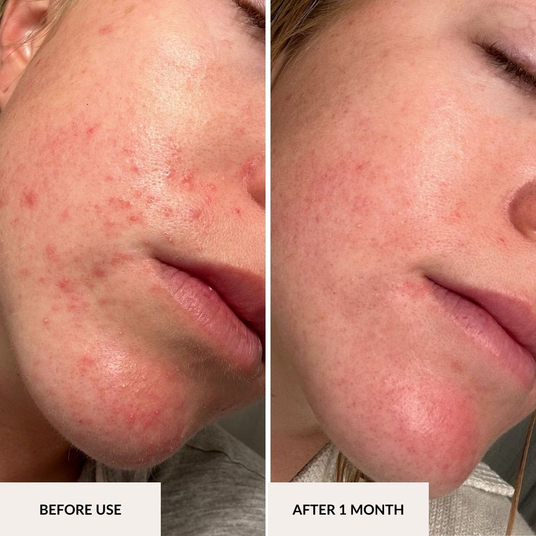 Before and after photos of a woman's face after using the Acne Prone Lotion for 1 Month.